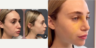 18-24 year old woman treated with Rhinoplasty - Rhinoplasty reveal: Our patient is one week post-op rhinoplasty! 