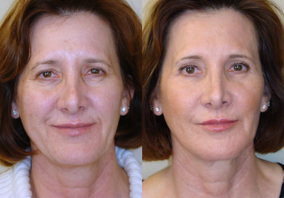 Active FX Treatment - The patient wanted to improve her skin quality, tone, texture, fine lines and wrinkles, pores, and acne scarring. We did an Active/ Deep FX treatment, and she maintains her results with good quality skin care, sun protection, and Botox and Juvederm injections.