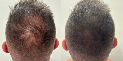45-54 year old man treated with Scalp Micropigmentation - Before and after SMP treatment to the crown.