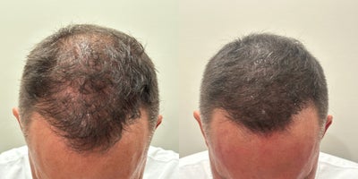 45-54 year old man treated with Scalp Micropigmentation - Before and after SMP treatment to the crown.