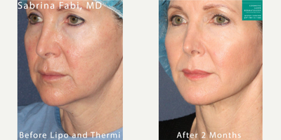 45-54 year old woman treated with Collagen Injection - Chin liposuction to remove submental fat and ThermiTight to firm up the skin by Dr. Fabi