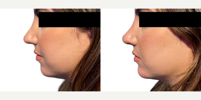 Woman treated with Dermal Fillers - Woman treated withDermal Fillers