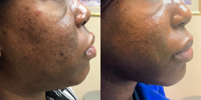 35-44 year old woman treated with Pico Genesis - After 1 treatment