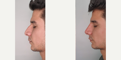 25-34 year old man treated with Nonsurgical Nose Job - Patient before and after liquid rhynoplasty