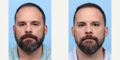 35-44 year old man treated with FUE Hair Transplant, Hair Transplant, Hair Loss Treatment, PRP for Hair Loss, PRP Injections - This patient underwent an FUE hair transplant and one session of PRP therapy with Dr. Wise to restore a receding front hairline and enhance overall thickness. The procedure helped achieve a more youthful, balanced appearance with improved hair coverage and density.