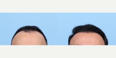 35-44 year old man treated with FUE Hair Transplant, Hair Transplant, Hair Loss Treatment, PRP for Hair Loss, PRP Injections - This patient underwent an FUE hair transplant along with one session of PRP therapy with Dr. Wise to restore a receding front hairline, thinning at the temporal lobes, and hair loss at the top center of the scalp. The result is a fuller, more natural-looking hairline that enhances his overall appearance and confidence.