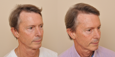 55-64 year old man treated with Hair Transplant - linear FUT - Here's a 62 year old man 9 months following his hair transplant procedure. Many people still think it's a pluggy look, or the results look like doll's hair. Look closely at his new hair in the bottom 2 photos...look like doll's hair? No, it looks natural, as it should. The new hair transplanted in a hair restoration procedure should look like it was always there, and not like somebody put it back. Notice how much younger he looks in the bottom 2 panels.&nbsp;You're never too old to look and feel your very best!