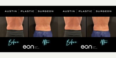 35-44 year old man treated with Eon - Eon Fat Reduction in Austin and San Antonio