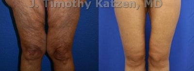Thigh Lift after massive weight loss - Before and after picture of inner thigh lift after massive weight loss. - Individual Results May Vary