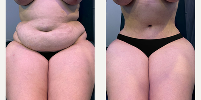 Woman treated with Tummy Tuck - This patient is a 25-35 year old female. The patient was treated with the Ultimate Silhouetteplasty which includes abdominoplasty with correction of rectus diastasis, and liposuction of the abdomen, hips, midback.