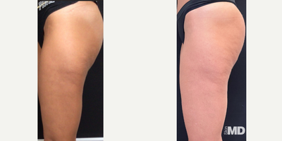 45-54 year old woman treated with Venus Legacy - Impressive results addressing skin texture and tone with Venus legacy over 8 treatment series.