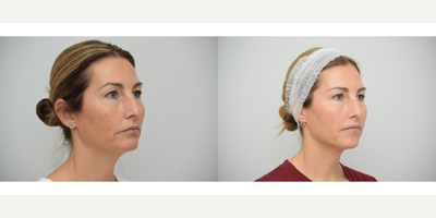 35-44 year old woman treated with GentleLase, Dysport, Revanesse, RHA Collection Fillers - Combination aesthetic treatment (Precise Aesthetic Balance) of Alex Gentelase laser for sun spots and skin photodamage to brighten skin tone and Dysport to glabella to relax tension frown lines, aka 11s, and Versa Hyaluronic Acid Filler in smile lines (nasolabial folds and marionettes) to soften wrinkle lines around the mouth.