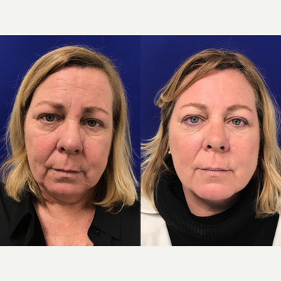 55-64 year old woman treated with Belotero - My 55 year old patient was not happy with her tired appearance. She didnt want anything surgical but wanted to look refreshed. Here she is after Botox in the forehead and crows feet area, Voluma in her cheeks to add volume and lift the lower face, and Belotero in the tear trough (undereye area) & peri oral lip lines. 2 weeks later, she looks refreshed & rejuvenated. Her other non-invasive options going forward are C02 Laser & full face & neck Ultherapy.