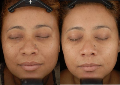 Woman treated with eMatrix - Woman treated with eMatrix