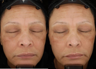 Woman treated with eMatrix - Woman treated with eMatrix