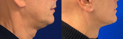 53 year old man treated with Mini Lift - 53 year old man unhappy with the sagging of skin in his lower face and neck treated with Mini Lift, shown 3 months post op. Patient was also treated with neck lift and facial fat transfer.
