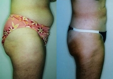 Female patient who underwent a butt lift - 
	With 2 sessions of suctioning of the abdomen, buttocks, and thighs, spaced about 6 months apart coupled with routine exercise and dieting.
