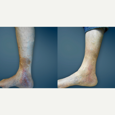 55-64 year old man treated with Varithena - This patient had suffered with a venous ulcer for approximately 8 months before she was referred to us for vein treatment. Venous ulcers are the most serious complication patients with varicose veins can develop. After doing the Varithena procedure and sealing off all of his bad veins,