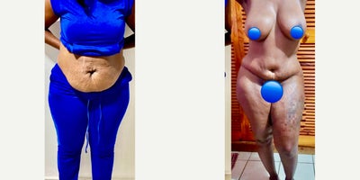 45-54 year old woman treated with Tummy Tuck - 45-54 year old woman treated with Tummy Tuck