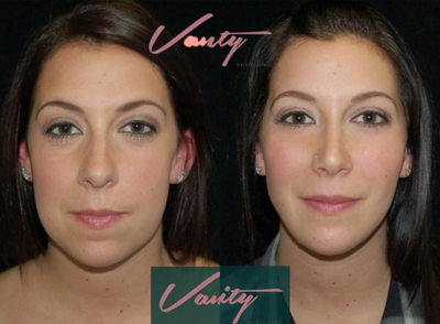 35-44 year old woman treated with Buccal Fat Removal - Buccal Fat Removal