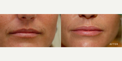 35-44 year old woman treated with Lip Implants - This woman received SurgiSil Perma Facial Implants in her upper and lower lip to give her a permanent lip augmentation.