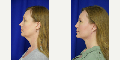 2775 45-54 year old woman treated with Facelift, Brow Lift, Buccal Fat Removal, Eyelid Surgery, Facial Fat Transfer - 45-54 year old woman treated with Facelift, Neck Lift, Facial Fat Transfer, Eyelid Surgery