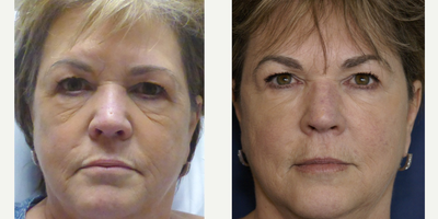 45-54 year old woman treated with Non Surgical Face Lift - Treated with Botox and Fillers. Eyebrow lift performed with Botox