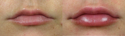 Woman treated with Lip Implants - Woman treated with Lip Implants