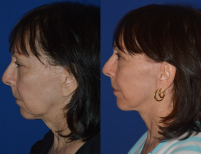55-64 year old woman treated with Neck Lift - Deep plane face and neck lift under local anesthesia.