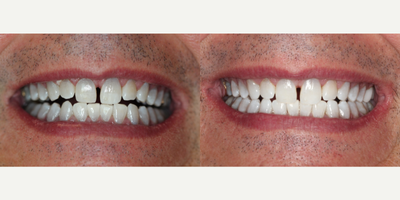 65-74 year old man treated with KoR Teeth Whitening - This patient had whitened with Zoom! Whitening previously which removed surface staining but not the instrinsic staining. Over the course of 6 weeks with Kor whitening we were able to remove much of the grey found in this patient's smile, leaving him with a bright, white smile.