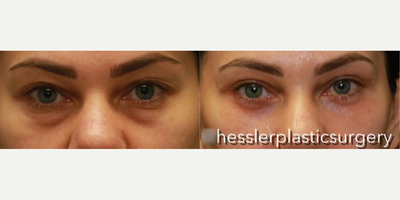 Woman treated with Facial Fat Transfer - Woman treated with Eyelid Surgery (transconjunctival lower eyelid blepharoplasty and upper eyelid blepharoplasty) and Facial Fat Transfer.