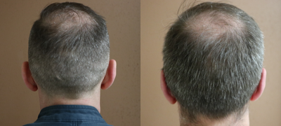 35-44 year old man treated with Ear Surgery - This gentleman felt uncomfortable with his protruding ears and was seeking Otoplasty to help reduce the prominence. He is seen here before and 6 weeks postoperative. The procedure was performed under local anesthesia in the office.