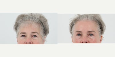 55-64 year old woman treated with Brow Lift, Eyelid Surgery, CO2 Laser - 62 year old 2 months after Brow lift and upper blepharoplasty and co2 laser with Dr. Madnani
