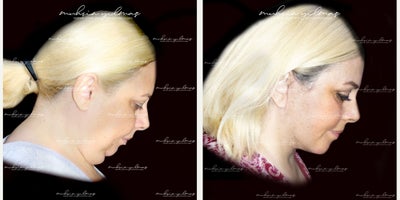 45-54 year old woman treated with Deep Plane Facelift, Neck Lift, Chin Implant, Buccal Fat Removal - This 45-54-year-old patient underwent a combination of Deep Plane Facelift, Neck Lift, Chin Implant, and Buccal Fat Removal to achieve a harmonious and rejuvenated facial appearance. The Deep Plane Facelift lifted and redefined the deeper facial tissues, restoring youthful contours. The Neck Lift addressed sagging skin and created a smoother neck profile, while the Chin Implant enhanced chin projection for a more balanced facial structure. Buccal Fat Removal further refined her mid-face by reducing fullness, resulting in a slimmer and more sculpted look. At 6 months post-operative, the patients results highlight the natural-looking and transformative outcomes achieved through these combined procedures, enhancing her confidence and overall appearance.