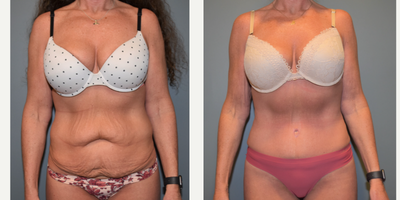 45-54 year old woman treated with Tummy Tuck, Liposuction, Mommy Makeover - This 48 year old woman is 5' 9 and 160 pounds. She has had one child via C-section. She had pre-eclampsia during her pregnancy and gained a significant amount of weight. She has lost the weight but this has left her with a lot of loose skin. We began her mommy make over with an abdominoplasty, (tummy tuck), and liposuction to the flanks, (love handles). Her results are shown after just two months.