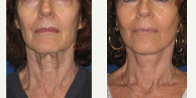 65-74 year old woman treated with a Face and Neck Lift - Pt was not happy with her heavy neck sagging and banding. She underwent a lower face and neck lift.