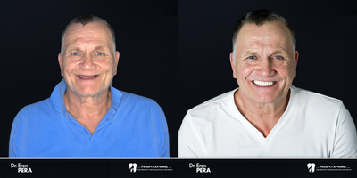 55-64 year old man treated with Zygomatic implant - zygomatic implant