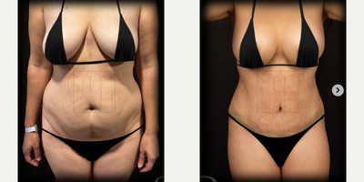 Woman treated with Mommy Makeover - A mommy makeover is a planned combination of procedures which recommended patients after birth or weight loss with unwanted changes of body in safety limits. That points to help to regain the great looking body you had before pregnancy, or make it look even better than ever. For our patient we performed breast up lift combined with liposuction and tummy tuck.