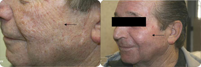 Pixel Laser - Using a Pixel Laser for Skin Resurfacing.