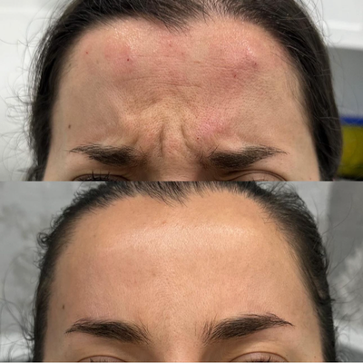 25-34 year old woman treated with Dysport, Botox - Female following neurotoxin treatment for the prevention of wrinkles using Dysport