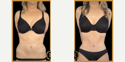 55-64 year old woman treated with Tummy Tuck / Tummy Tuck Revision - 55-64 year old woman treated with Tummy Tuck / Tummy Tuck Revision