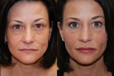 Non-Surgical Facial Rejuvenation with Silikon-1000. 2 treatments. - 
	These photos demonstrate non-surgical facial rejuvenation with Silikon-1000, an off-label filler for permanent results. My patient from Newton, NJ had 2 treatments with silikon-1000. She had correction of her under-eye grooves, nasolabial folds, lips, and left cheek depression.&nbsp;
