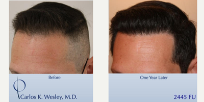 Patient treated with FUE Hair Transplant, Hair Loss Treatment, Hair Transplant - This 43-year-old man underwent a follicular unit extraction (FUE) session with Dr. Carlos K. Wesley in which a total of 2445 grafts were placed.