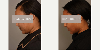 Woman treated with Buccal Fat Removal - Woman treated with Chin/Neck Liposuction, Cheek Liposuction, and Buccal Fat Removal to reduce the roundness of her face while still maintaining a natural look, shown 3 months post op.