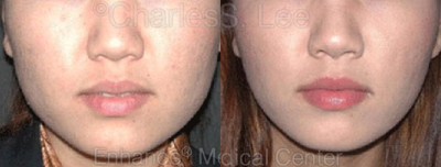 Jaw Reduction - Non-surgical Jaw Reduction