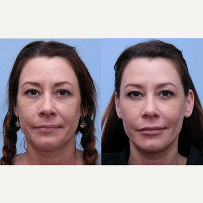 35-44 year old woman treated with Non Surgical Face Lift - This woman wanted to look less tired. After Juvederm Vollure to her cheeks and tear trough, and Juvederm to her smile lines and lips, she looks much more well-rested and has regained her natural beauty