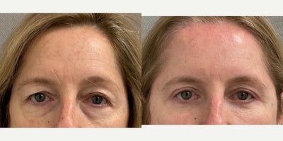 45-54 year old woman treated with Brow Lift - 52 yo s/p non endoscopic closed browlift and upper and lower blepharoplasty with skin pinch and canthopexy performed in our on site AAAA certified operating suite under local anesthesia with sedation