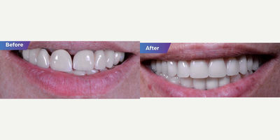 35-44 year old woman treated with All-on-4 Dental Implants - Upper Zirconia all-on-6