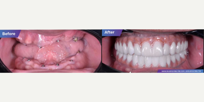 35-44 year old woman treated with All-on-4 Dental Implants - Upper and bottom Zirconia all-on-6