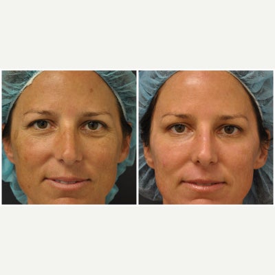 35-44 year old woman treated with Pixel Laser - I treated this patient for photodamage she was treated in the past by another Doctor but the brown spots returned after a couple years. The post op picture shows results just after 1 treatment. In conjunction with the Pixel Laser I also used the Alexandrite laser for brown spots and the Vbeam laser for redness.